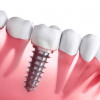 dental-implants-1a