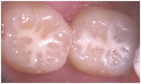 zaštićeni stalni zubi,sl1